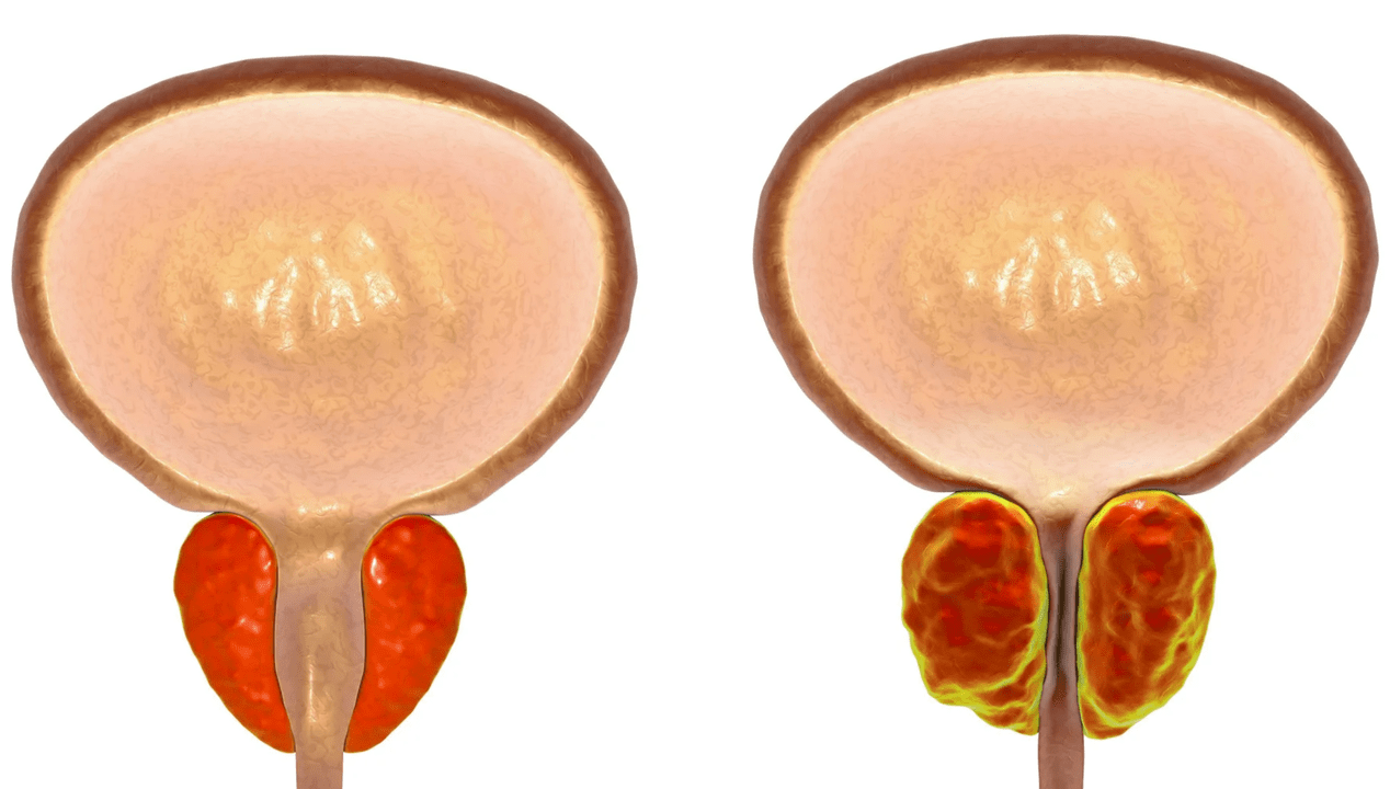 Что такое простатит